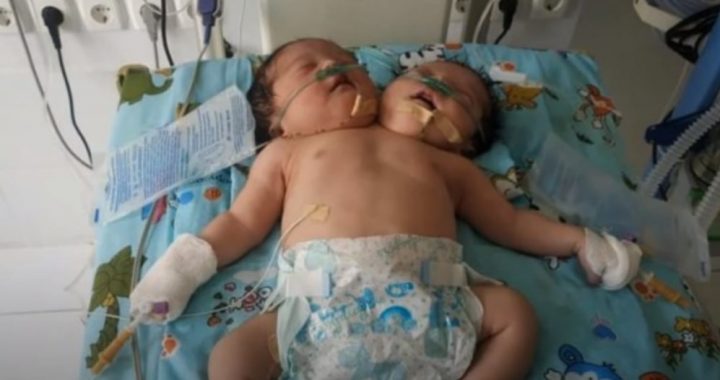 Двухголовые сиамские близнецы родились в Узбекистане. Родители отказались от них